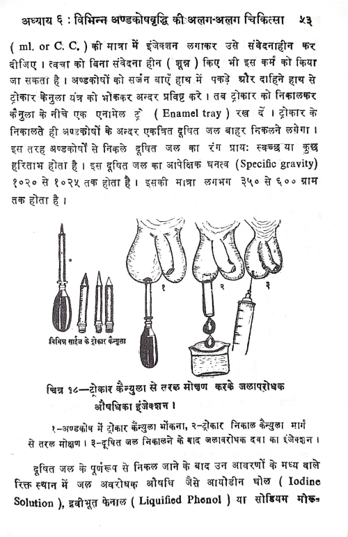 Hydrocele Aur Hernia Operation